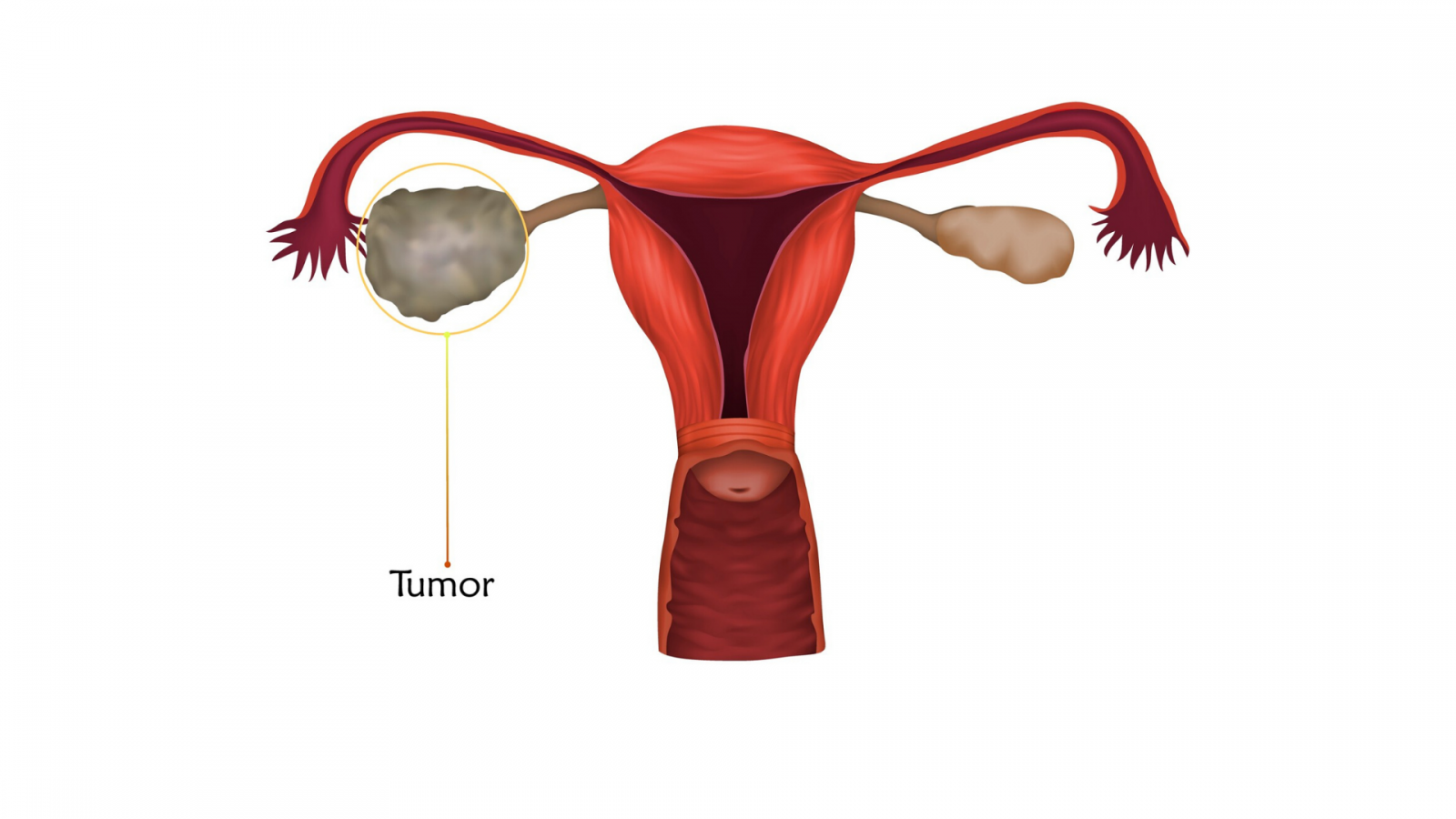 Staging and grading ovarian cancer Irish Cancer Society